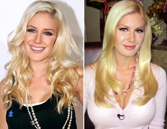 surgery gone wrong. Heidi Montag: Gone Too Far
